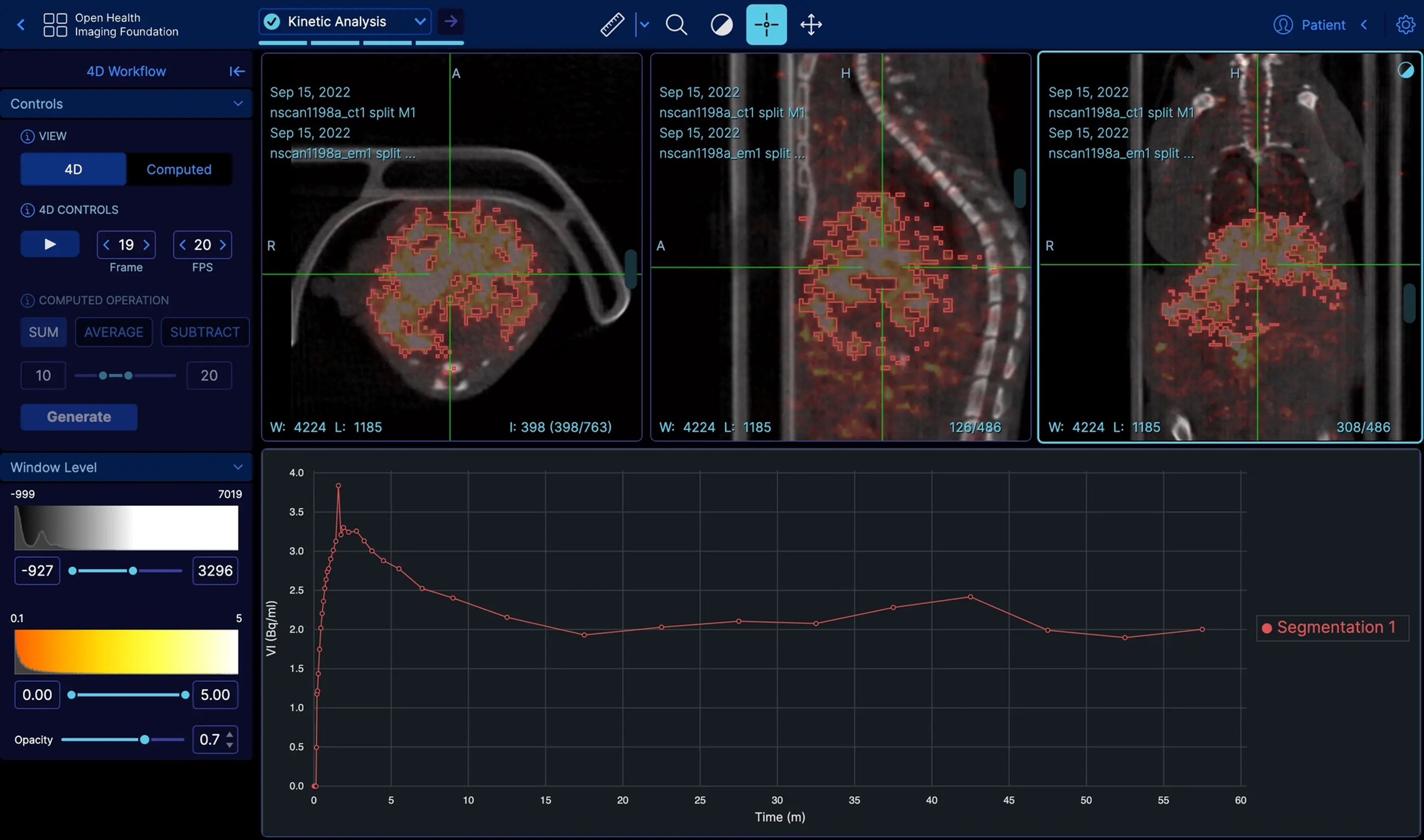 Open source OHIF viewer interface